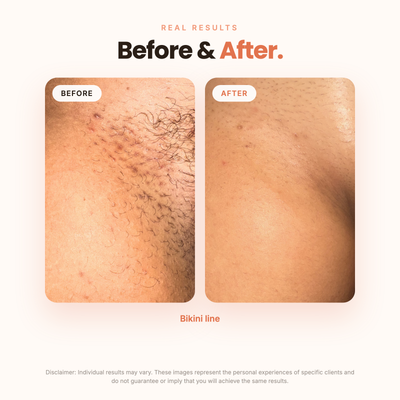BBL Serum