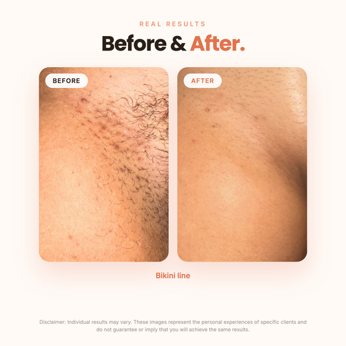 BBL Serum